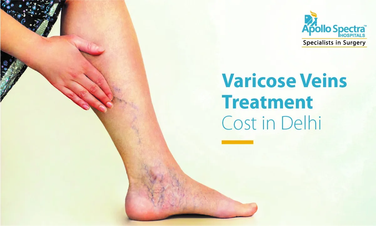 Varicose Veins Treatment Cost in Delhi